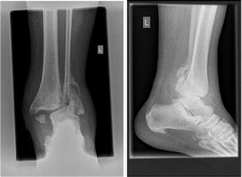 icd 10 for ankle replacement.